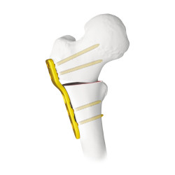 Nẹp Khóa Đầu Gần Xương Đùi Trẻ Em 2.7 (Titanium)