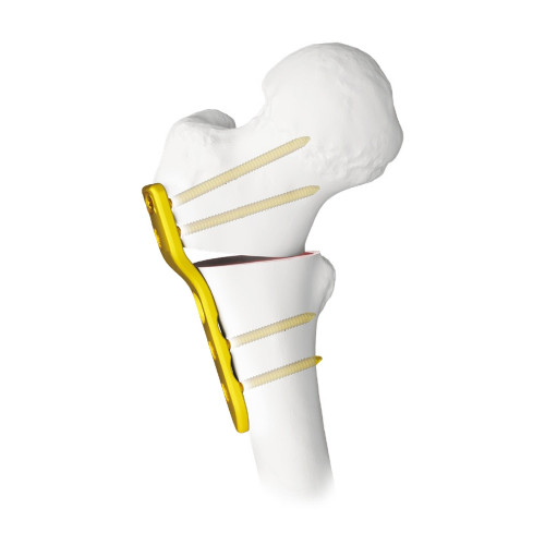 Nẹp Khóa Đầu Gần Xương Đùi Trẻ Em 2.7 (Titanium)