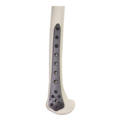 Nẹp Khóa Tái Tạo Cong -1 (Titanium)