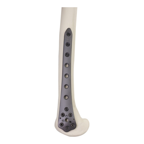 Nẹp Khóa Tái Tạo Cong -1 (Titanium)