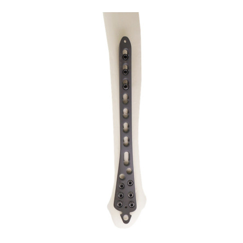 Nẹp Khóa Nén Ép Đầu Xa Mặt Trong Xương Chày -2 (Hợp kim Titanium) Nẹp Khóa Nén Ép Đầu Xa Mặt Trong Xương Chày -2 (Hợp kim Titanium)