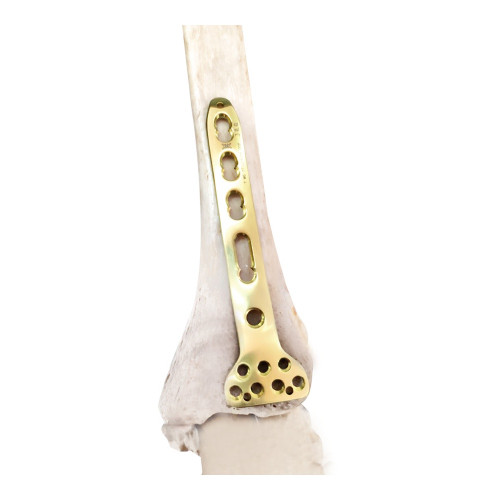 Nẹp Khóa Đầu Xa Mặt Sau Xương Chày (Titanium) Nẹp Khóa Đầu Xa Mặt Sau Xương Chày (Titanium)