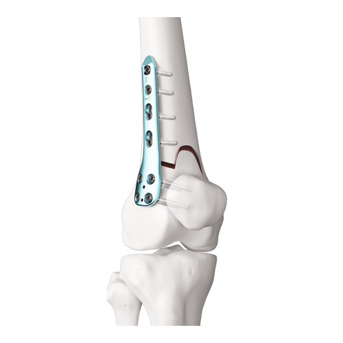 Nẹp Khóa Đầu Xa Mặt Ngoài Xương Đùi (Titanium)
