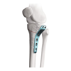 Nẹp Khóa Cắt Xương Chày Cao Chêm Mở Mặt Trong (Titanium)