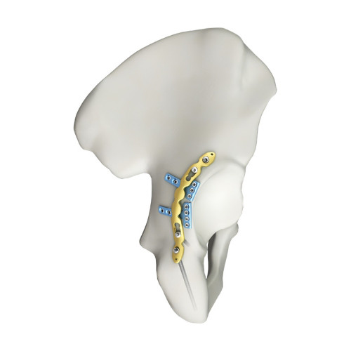 Nẹp Khóa Ổ Cối Phía Sau (Titanium) Nẹp Khóa Ổ Cối Phía Sau (Titanium)