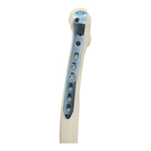 Nẹp Khóa Nén Ép Đầu Gần Mặt Ngoài Xương Đùi -2 (Hợp kim Titanium)