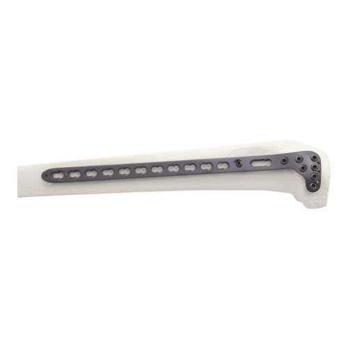 Nẹp Khóa Nén Ép Đầu Gần Mặt Ngoài Xương Chày -2 (Hợp kim Titanium)
