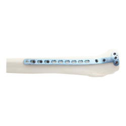 Nẹp Khóa Nén Ép Đầu Gần Mặt Trong Xương Chày -2 (Hợp kim Titanium)