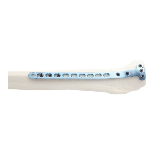 Nẹp Khóa Nén Ép Đầu Gần Mặt Trong Xương Chày -2 (Hợp kim Titanium) Nẹp Khóa Nén Ép Đầu Gần Mặt Trong Xương Chày -2 (Hợp kim Titanium)