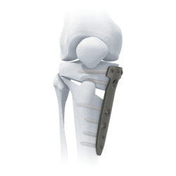 Nẹp Khóa Cắt Xương Chêm Mở Mặt Trong Đầu Gần Xương Chày (Titanium)