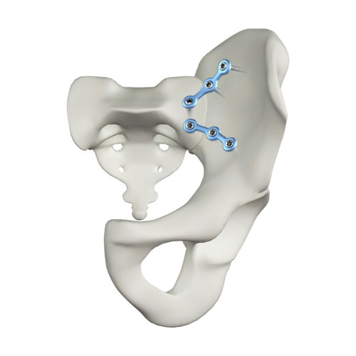 Nẹp Khóa Khớp Cùng-Chậu (Titanium) Nẹp Khóa Khớp Cùng-Chậu (Titanium)