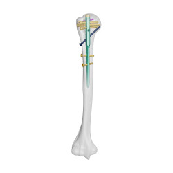 Đinh nội tủy xương cánh tay (TC20)