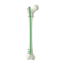 Đinh Nội Tủy Xương Đùi PROTEK (Hợp kim Titanium)