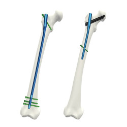 Đinh Nội Tủy Đầu Trên Xương Đùi We Nail II Tiêu Chuẩn (Hợp kim Titanium)