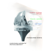 Bộ Khớp Gối Nhân Tạo (Knee Joint Prosthesis Set - Loại có xi măng) Bộ Khớp Gối Nhân Tạo (Knee Joint Prosthesis Set - Loại có xi măng)