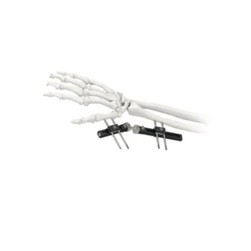 Dụng Cụ Cố Định Ngoài Cổ Tay Chỉnh Hình Tiêu Chuẩn Một Bên Tích Hợp Dụng Cụ Cố Định Ngoài Cổ Tay Chỉnh Hình Tiêu Chuẩn Một Bên Tích Hợp