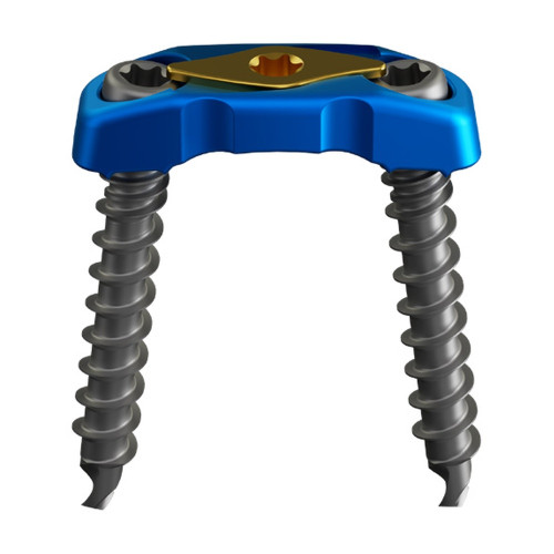 Nẹp Ngực-thắt Lưng Lối Trước (Hợp kim Titanium) Nẹp Ngực-thắt Lưng Lối Trước (Hợp kim Titanium)