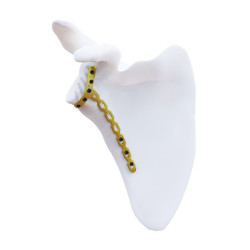 Nẹp khóa ổ chảo trước (A)