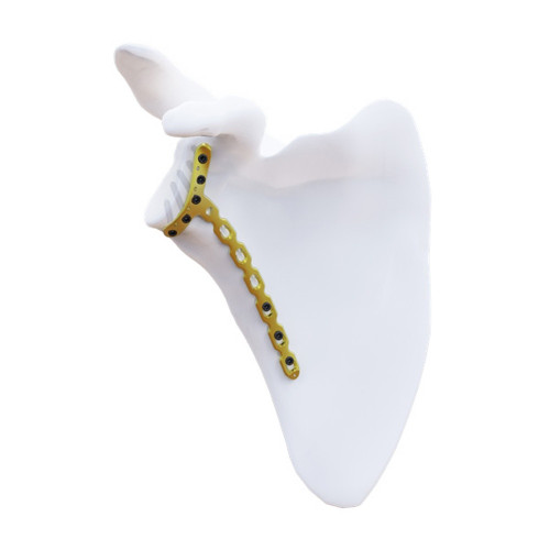 Nẹp khóa ổ chảo trước (A)