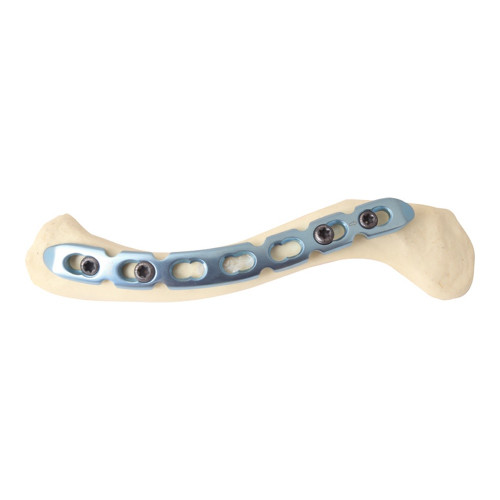Nẹp khóa nén ép xương đòn-2 (T)