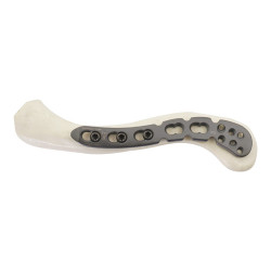 Nẹp khóa nén ép xương đòn-3 (A)