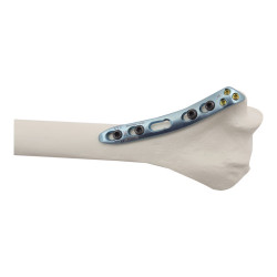 Nẹp khóa nén ép đầu dưới xương cánh tay mặt trong-2 (T)