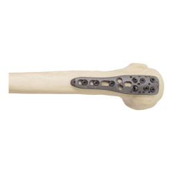 Nẹp Khóa Nén Ép Đầu Trên Xương Cánh Tay-2 (Titanium)