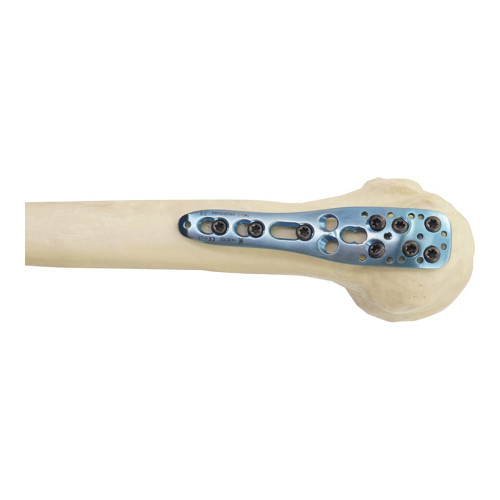 Nẹp khóa nén ép đầu trên xương cánh tay-2 (T) Nẹp khóa nén ép đầu trên xương cánh tay-2 (T)