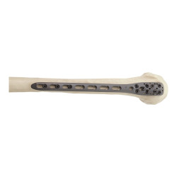 Nẹp Khóa Nén Ép Đầu Trên Xương Cánh Tay-3 (Titanium)