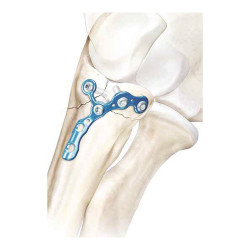 Nẹp khóa mỏm vẹt xương trụ (A)