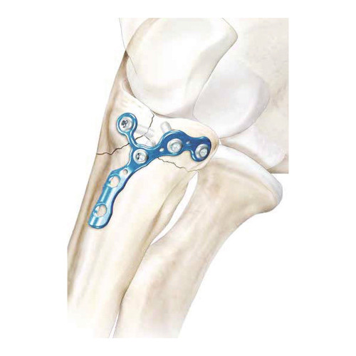 Nẹp khóa mỏm vẹt xương trụ (A)