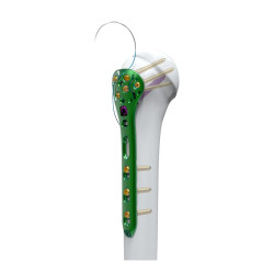 Nẹp khóa đầu trên xương cánh tay-2 đa hướng (TC20)